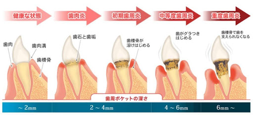 歯周病とは